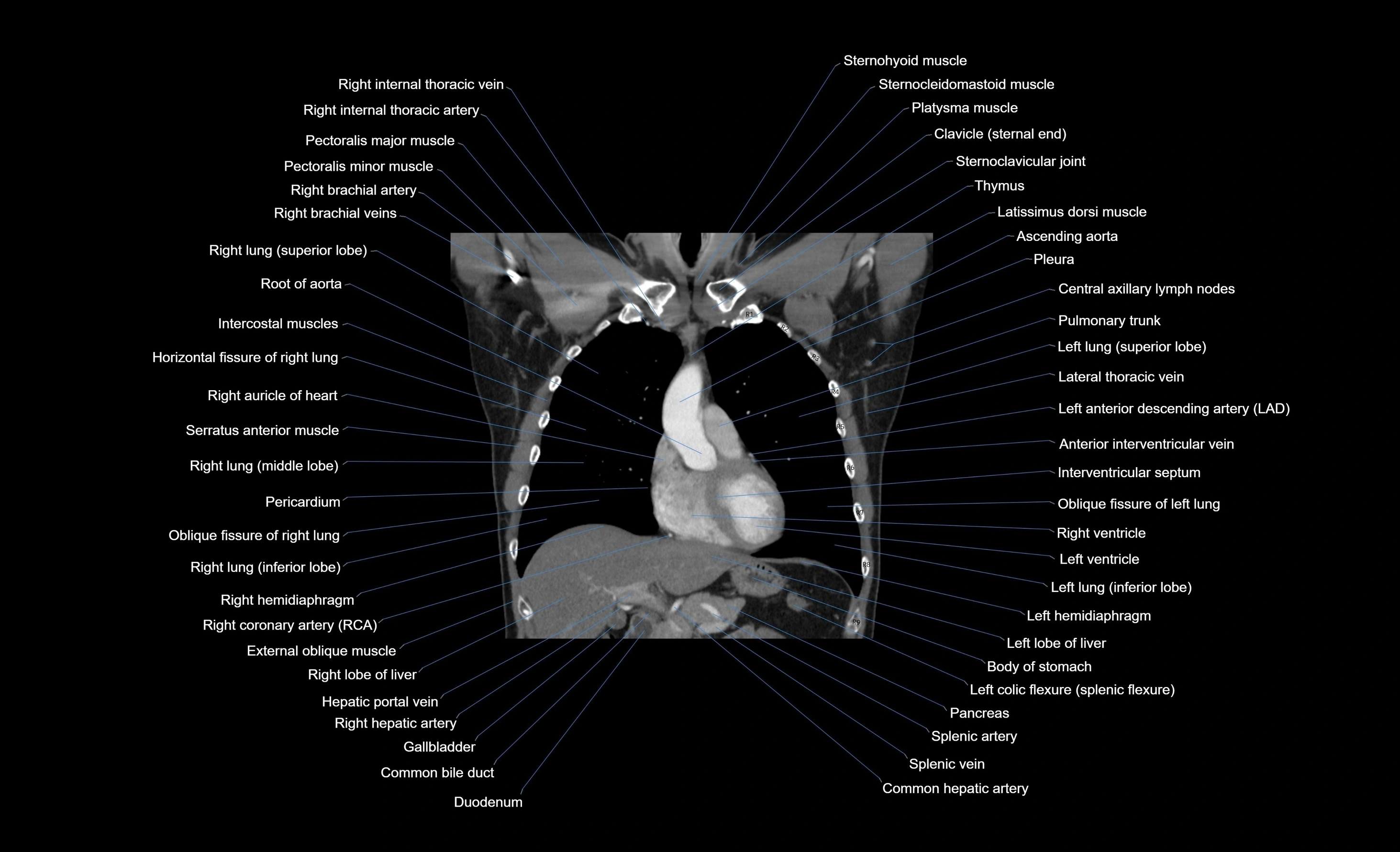 CT chest (thorax) soft tissue window labelled coronal cross sectional anatomy radiology image-00077.webp